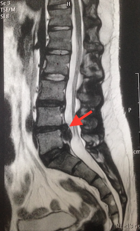 Caso de hérnia de disco na lombar que pode causar lombalgia intensa