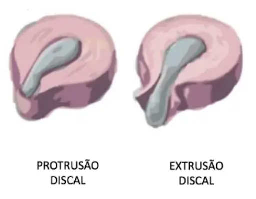Protrusão e extrusão discal são os dois tipos mais comuns de hérnia de disco