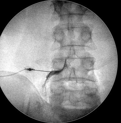 Bloqueio foraminal na coluna vertebral