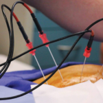 Rizotomia por Radiofrequência é um procedimento minimamente invasivo que visa promover o alívio da dor na coluna. Dr Eduardo Urbano