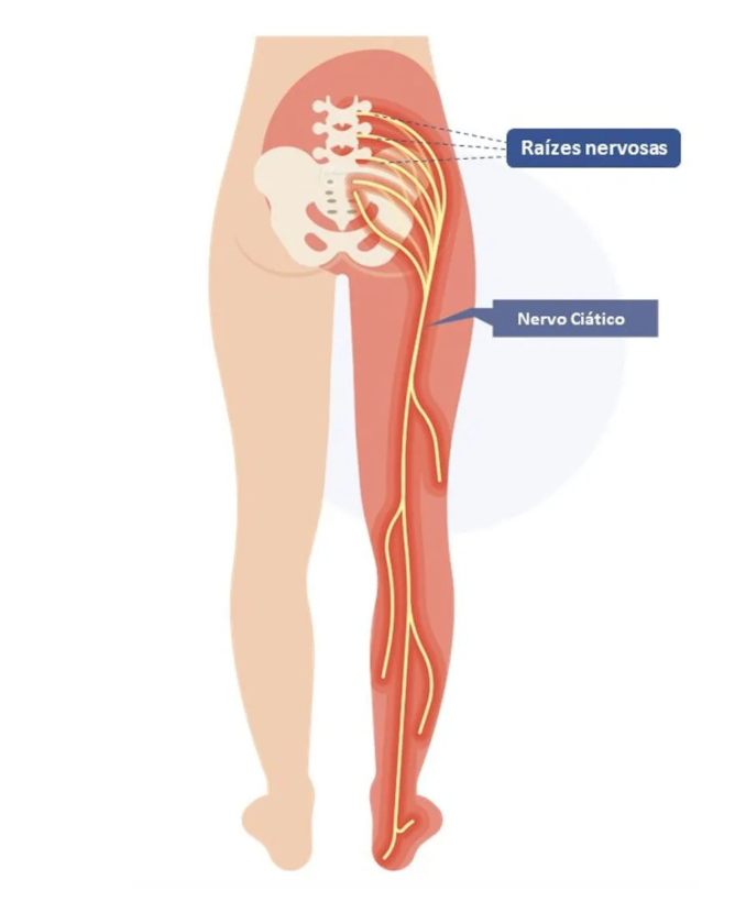 Extensão do nervo ciático, considerado o maior do corpo humano